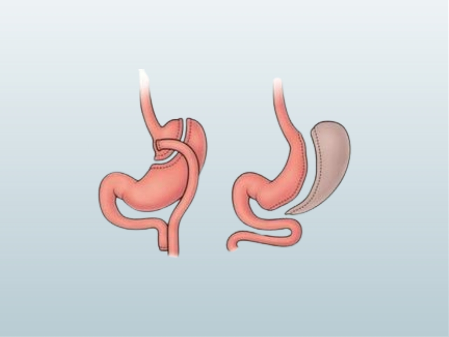 Prof. Dr. Ahmet Gökhan Türkçapar’ın Hastane Vizitlerinden İzlenimler: Obezite ve Metabolik Cerrahi